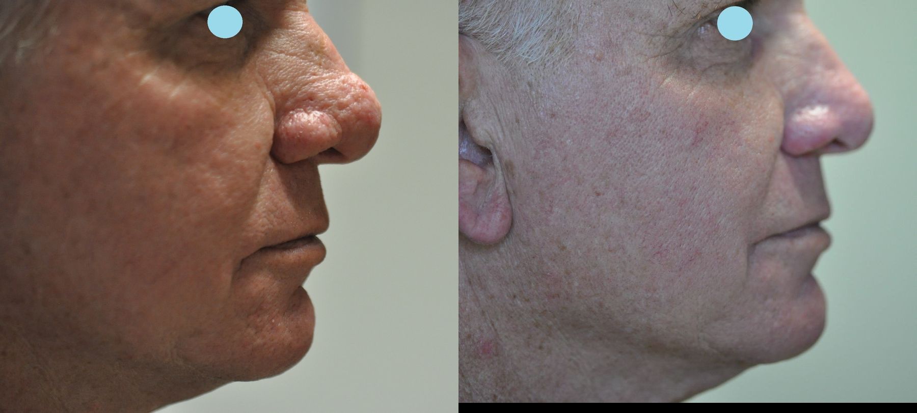 Before and after Lasers for Rhinophyma case 35824 - Angle 6