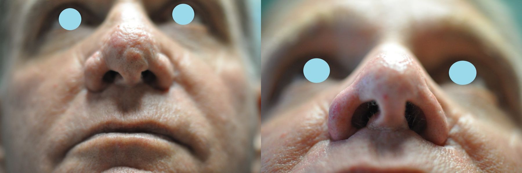 Before and after Lasers for Rhinophyma case 35824