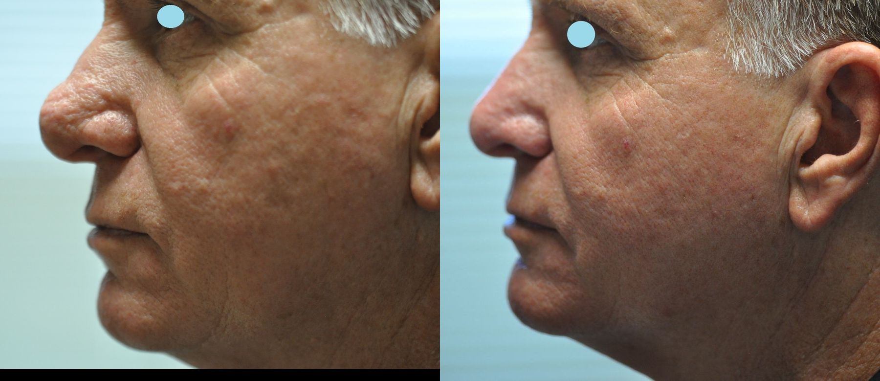 Before and after Lasers for Rhinophyma case 35824 - Angle 4