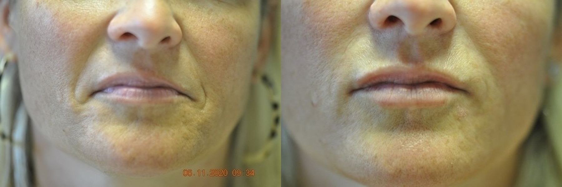 Before and after Lips and Mouth case 35701