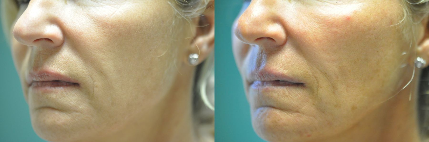 Before and after Loss of Fullness case 35735