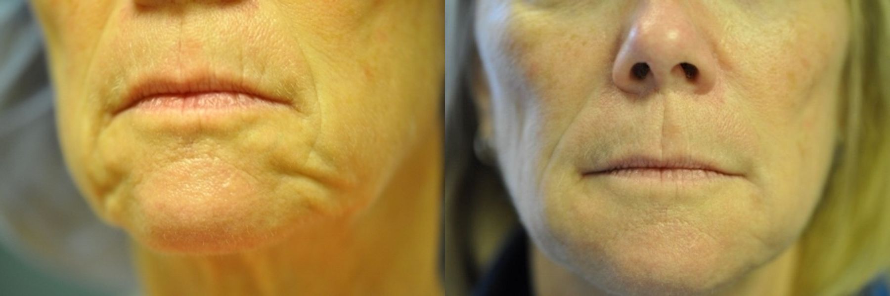 Before and after Loss of Fullness case 35519
