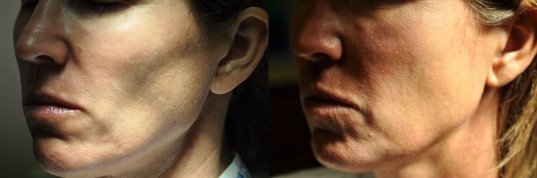 Before and after Loss of Fullness case 35734