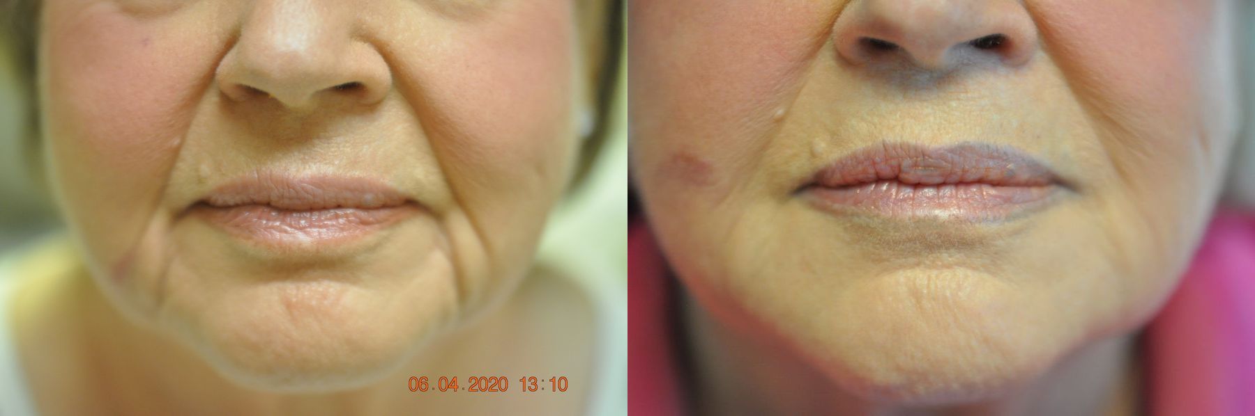 Before and after Marionette Lines case 35448