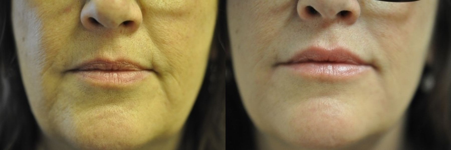 Before and after Marionette Lines case 35420