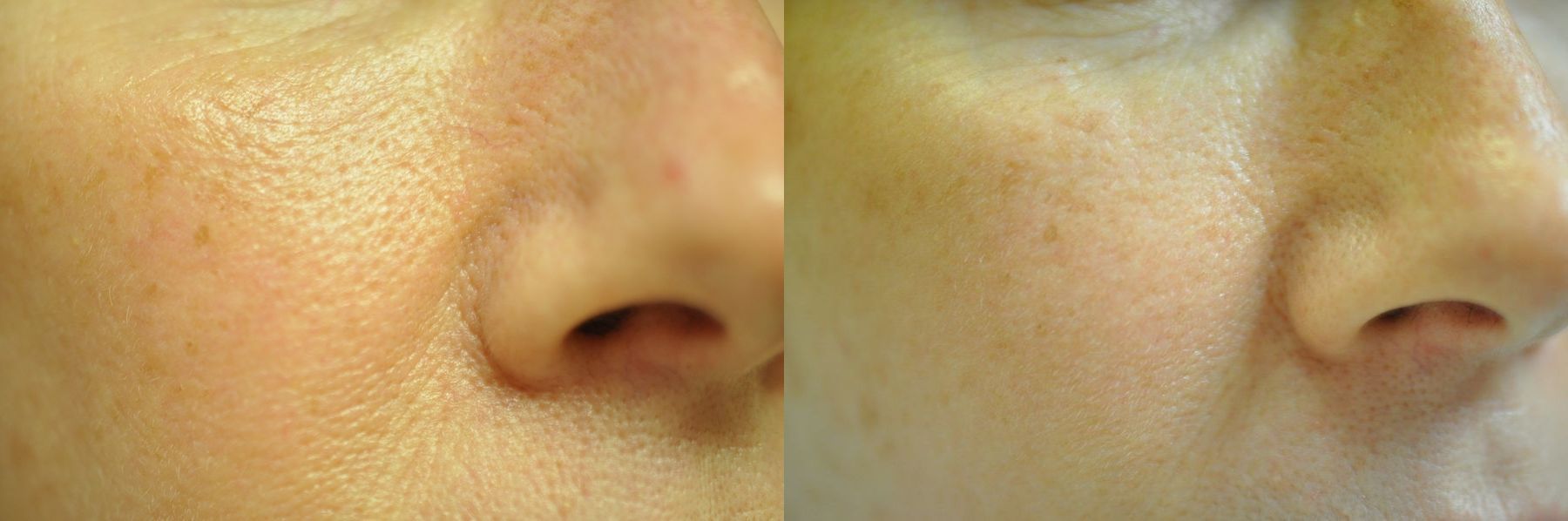 Before and after Microneedling case 35799