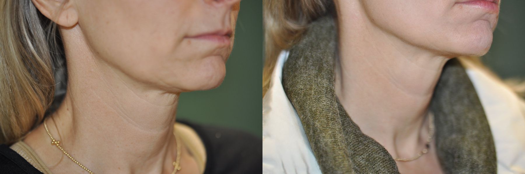 Before and after Microneedling case 50236