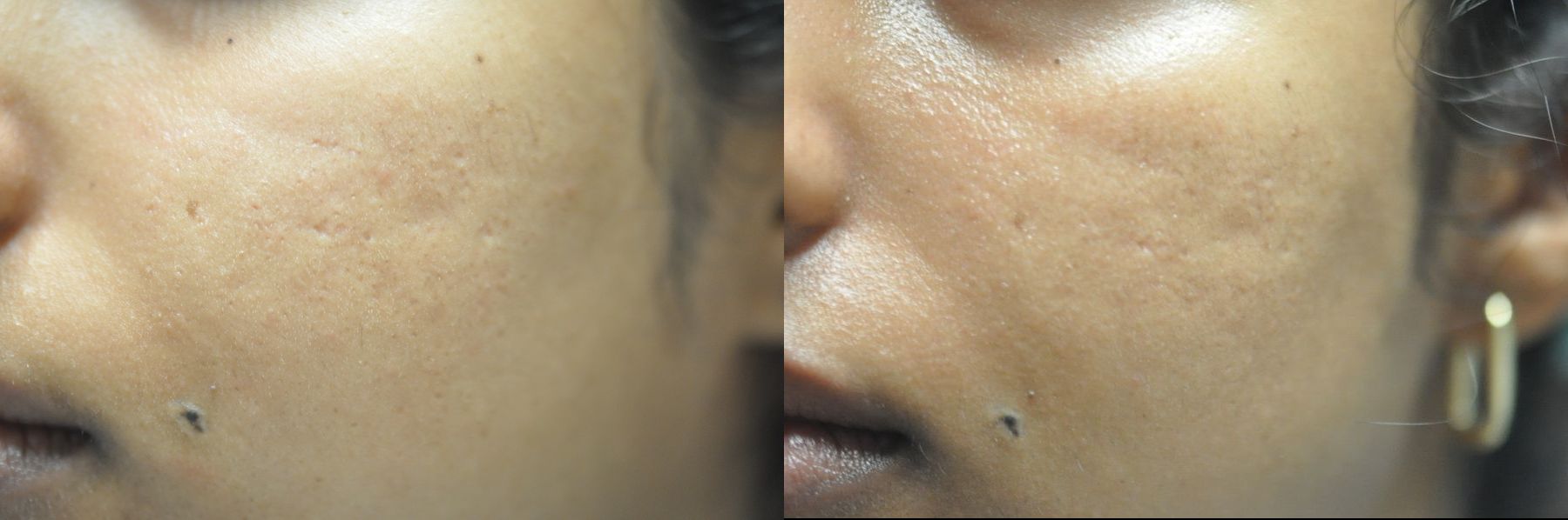 Before and after Microneedling case 35522