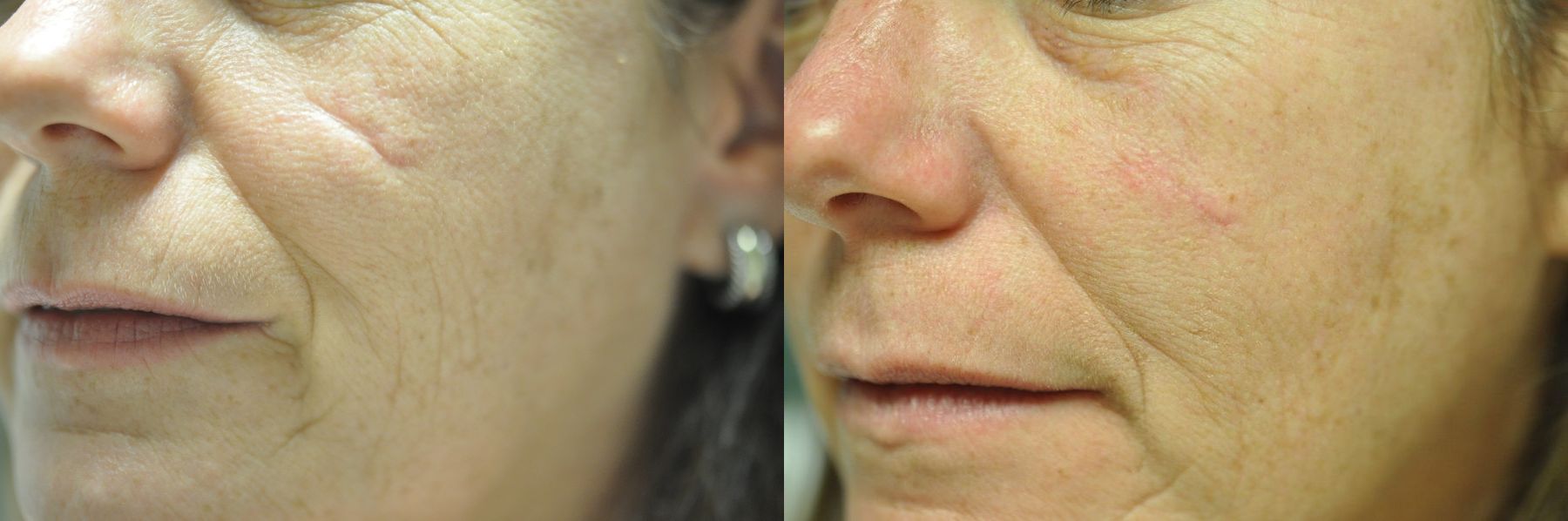 Before and after Scar Revision case 35737