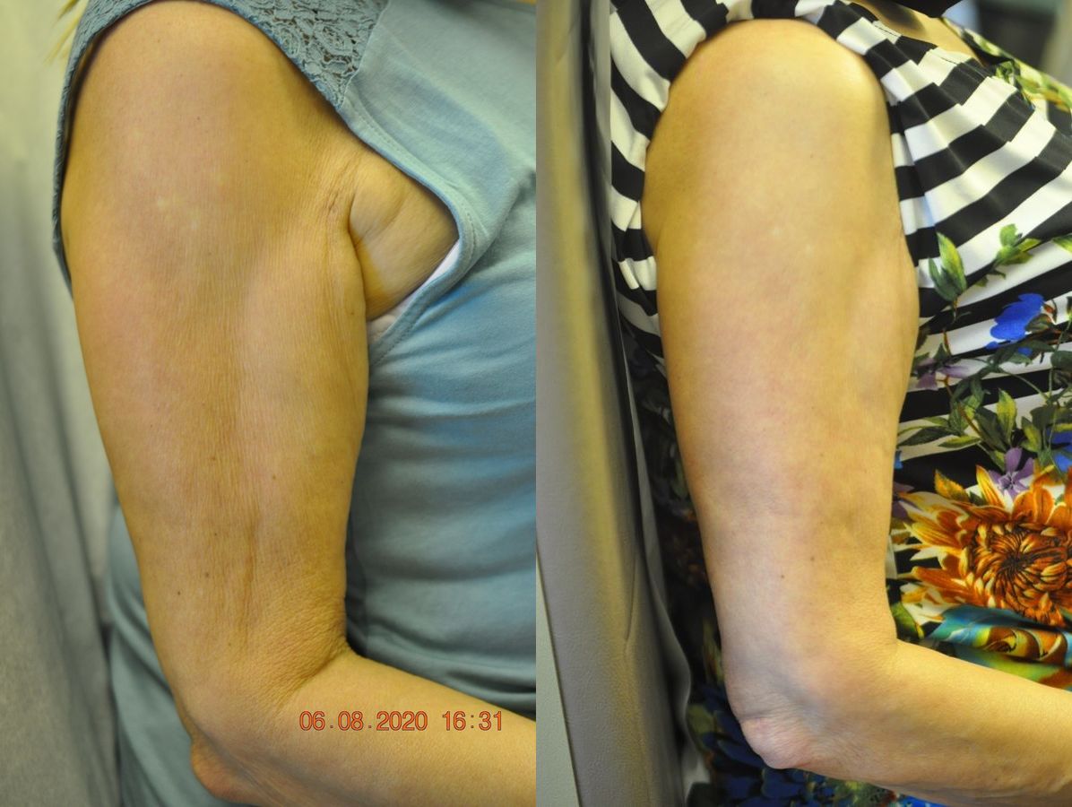 Before and after Skin Tightening case 35726