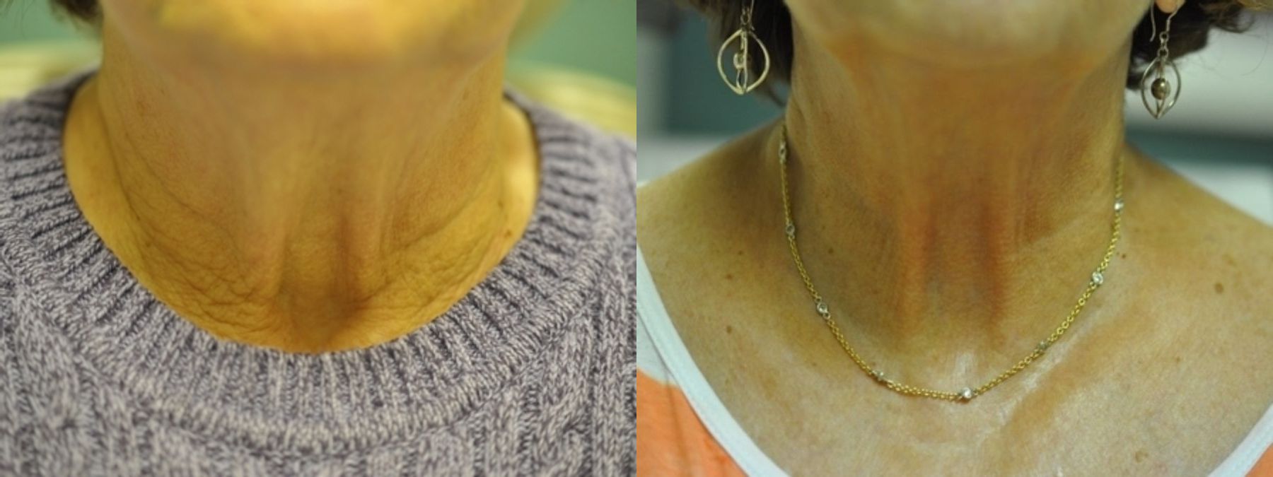 Before and after Skin Tightening case 35312