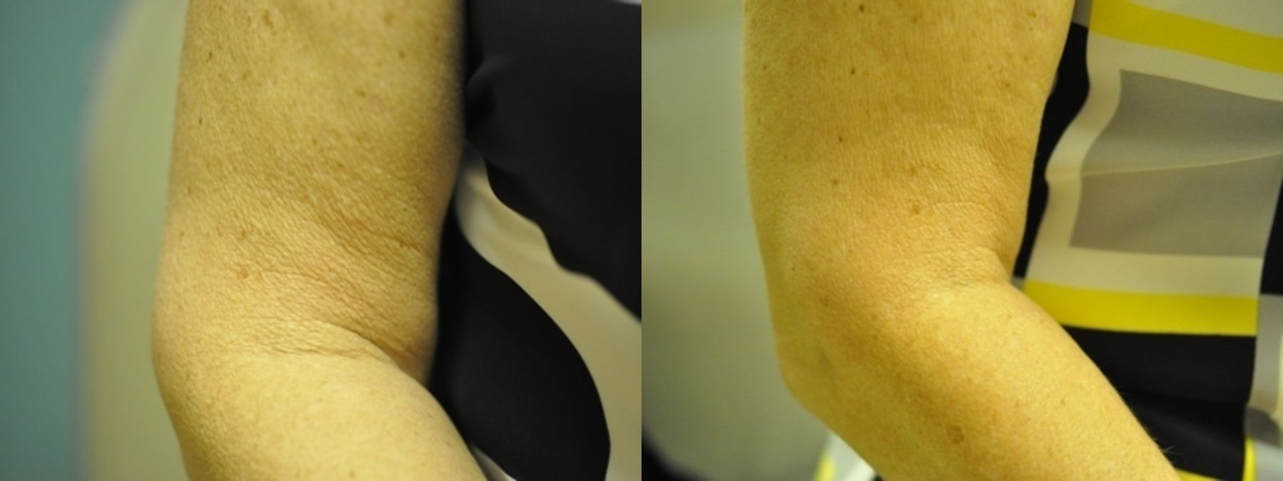 Before and after Skin Tightening case 35393