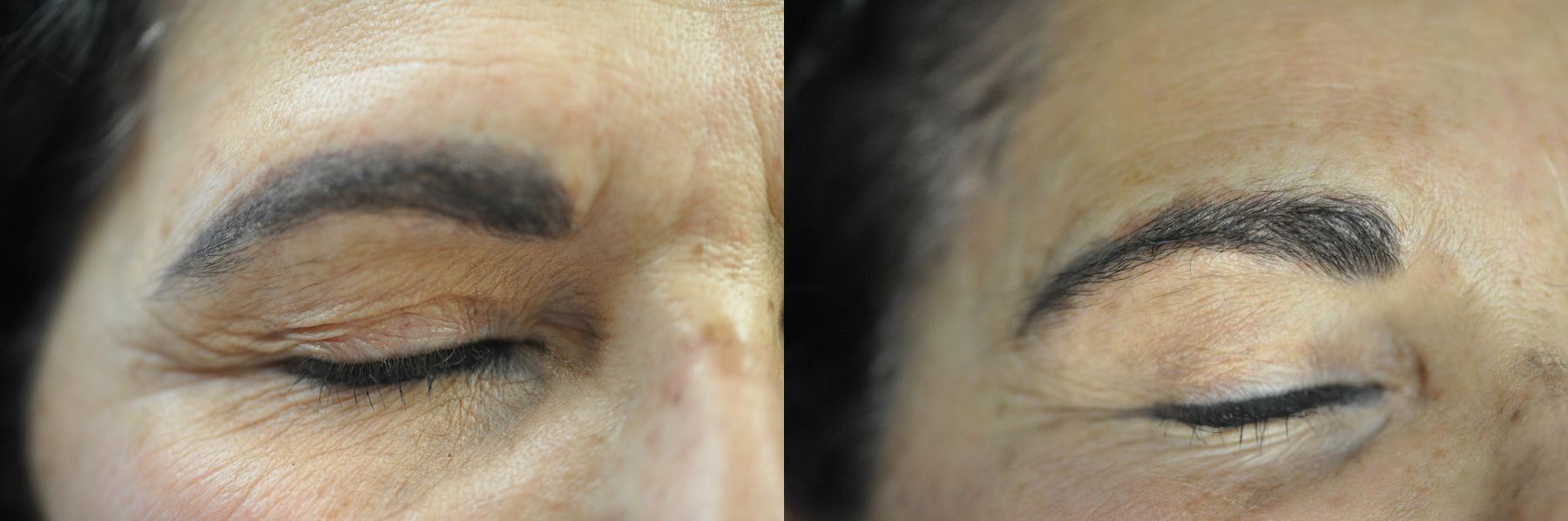 Before and after Tattoo Removal case 49650 - Angle 2
