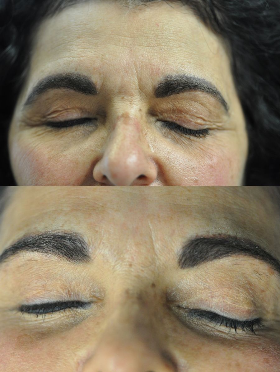 Before and after Tattoo Removal case 49650