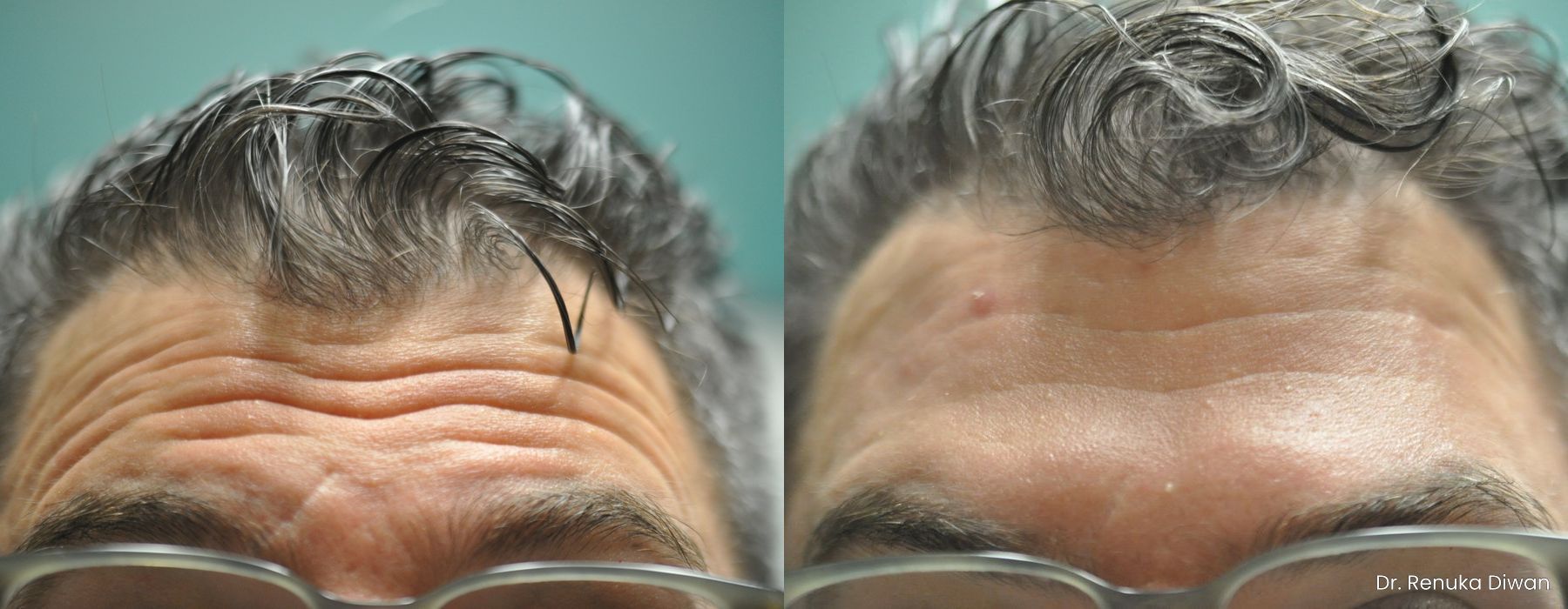 Forehead Creases - Thumbnail 2