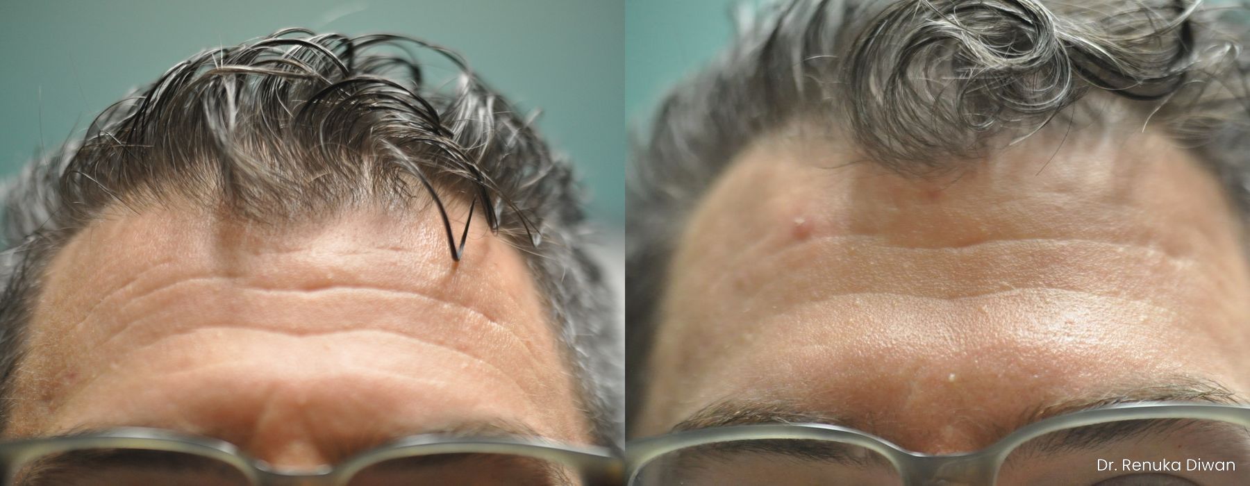 Forehead Creases - Case 1676