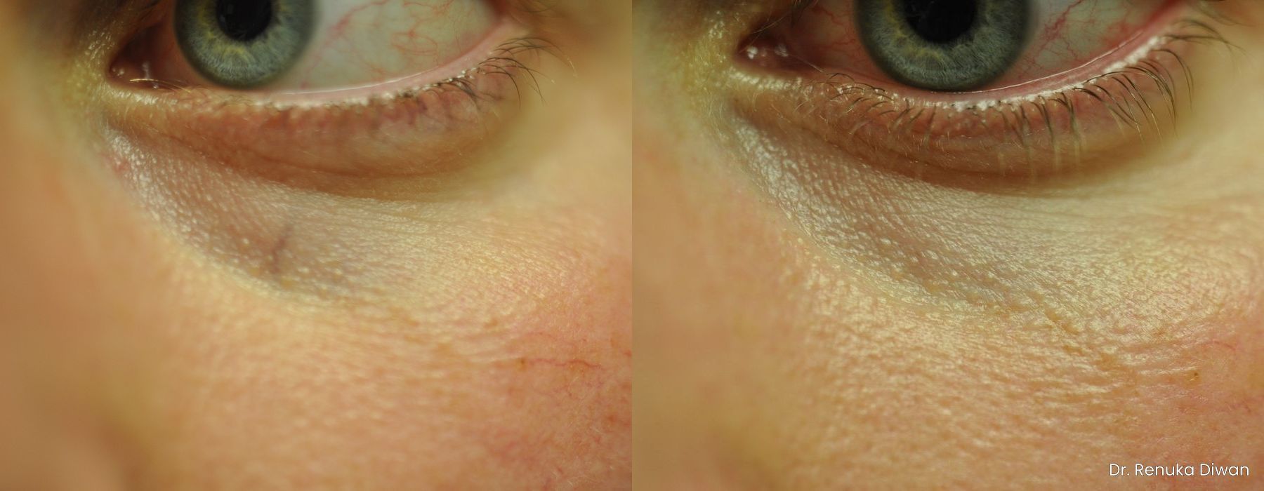 Laser for Veins and Redness - Case 1750
