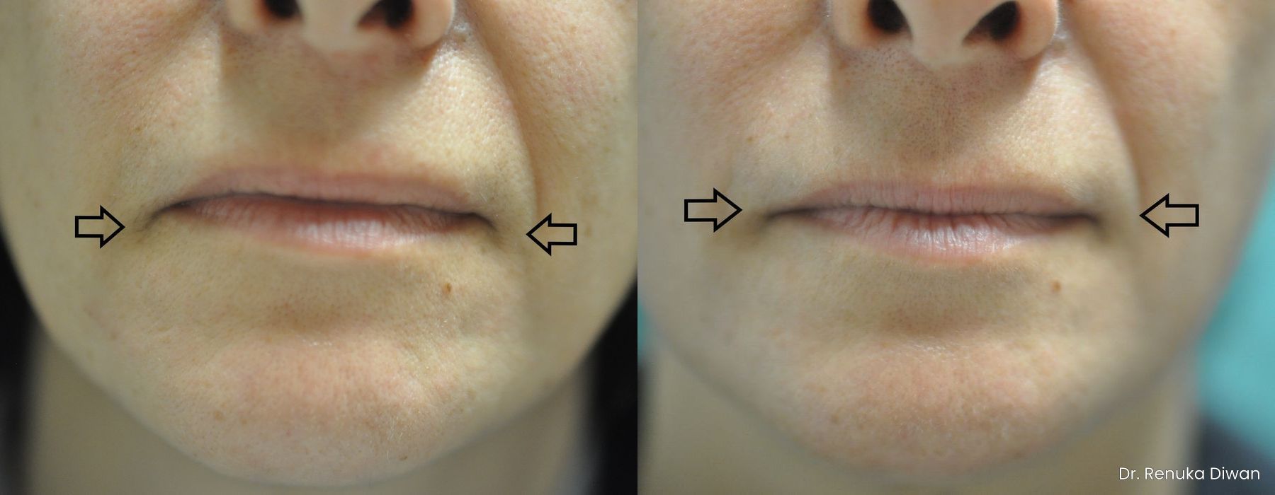 BOTOX® Cosmetic - Case 1583