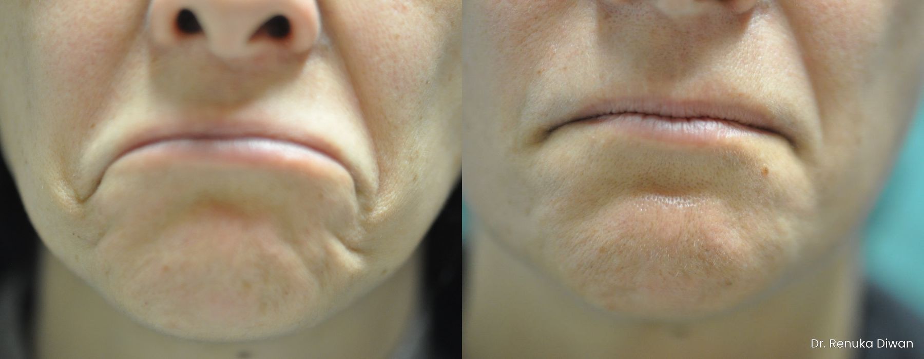 BOTOX® Cosmetic - Thumbnail 2