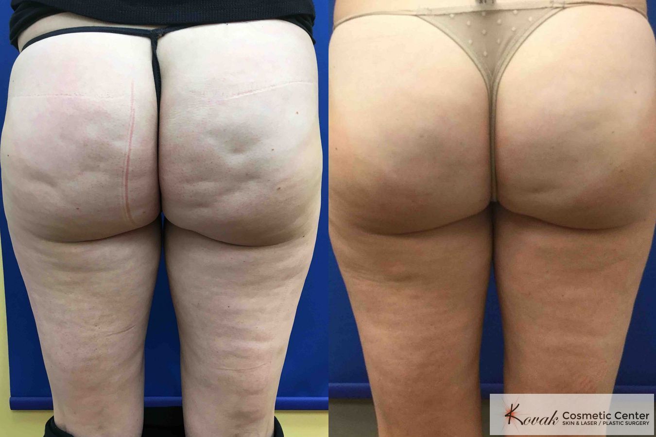 b12 injections cellulite Cellulite Reduction – Kovak Cosmetic Center Chicago Illinois