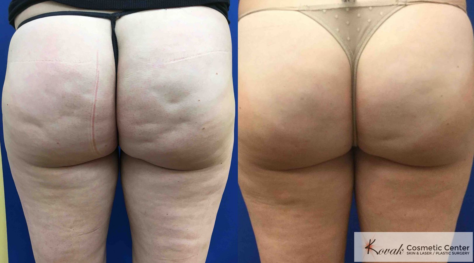b12 injections for cellulite Cellulite | Cellulite Removal b12 injections for cellulite Cellulite | Cellulite Removal