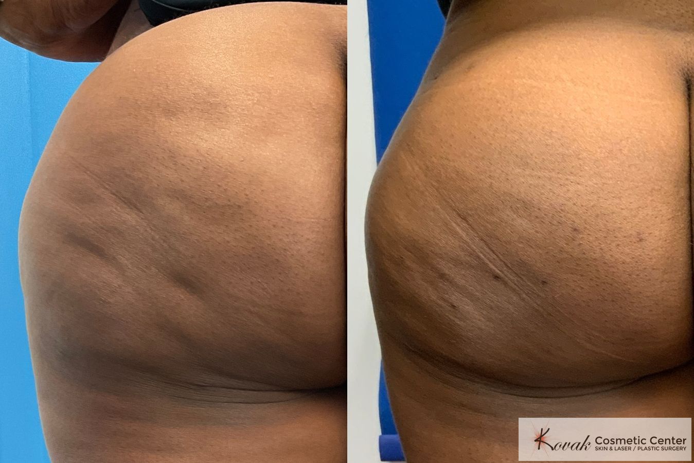 Cellulite Reduction Kovak Cosmetic Center Chicago Illinois Cellulite Reduction Kovak Cosmetic Center Chicago Illinois