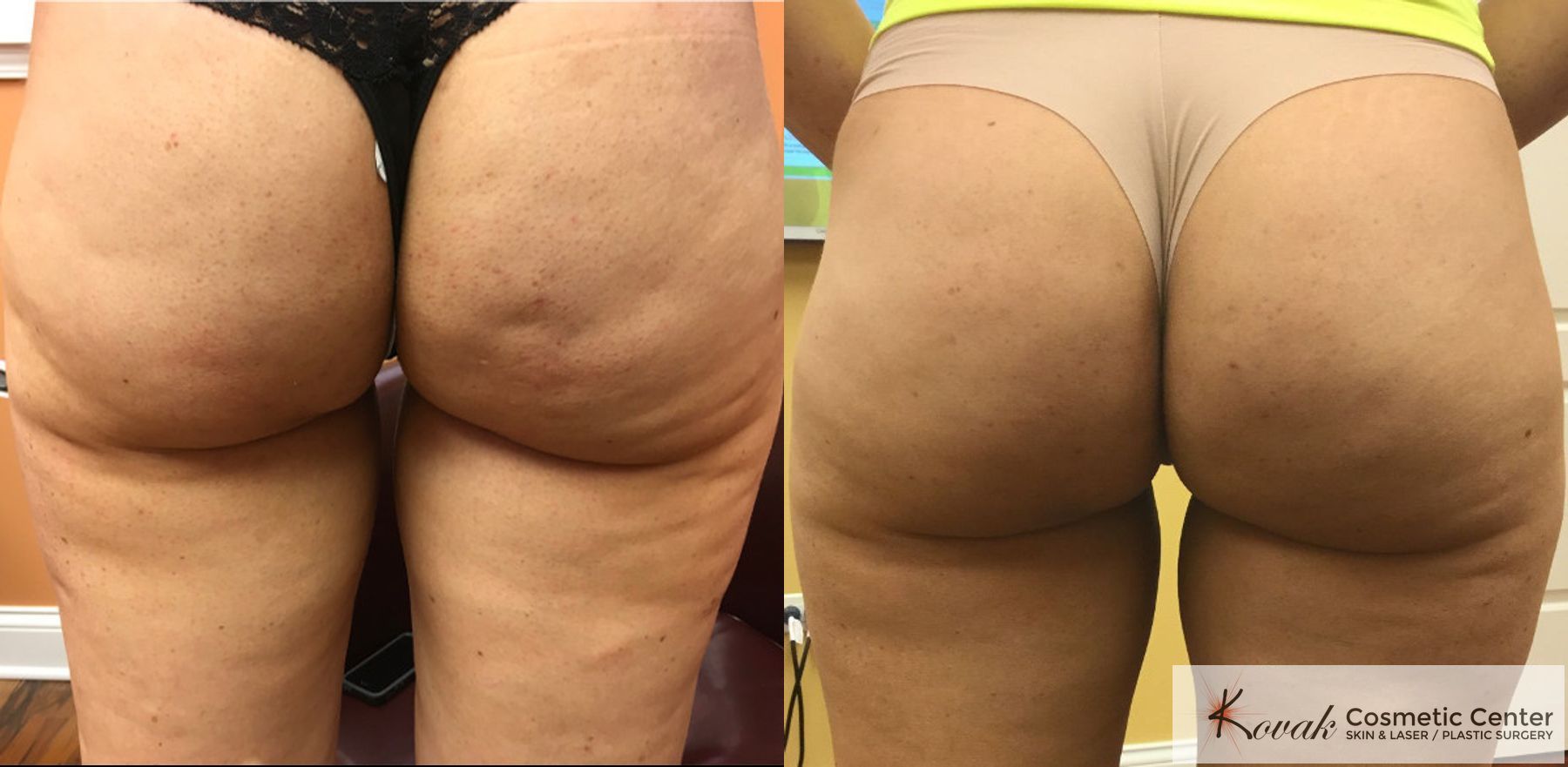 Cellulite Reduction Kovak Cosmetic Center Chicago Illinois Cellulite Reduction Kovak Cosmetic Center Chicago Illinois