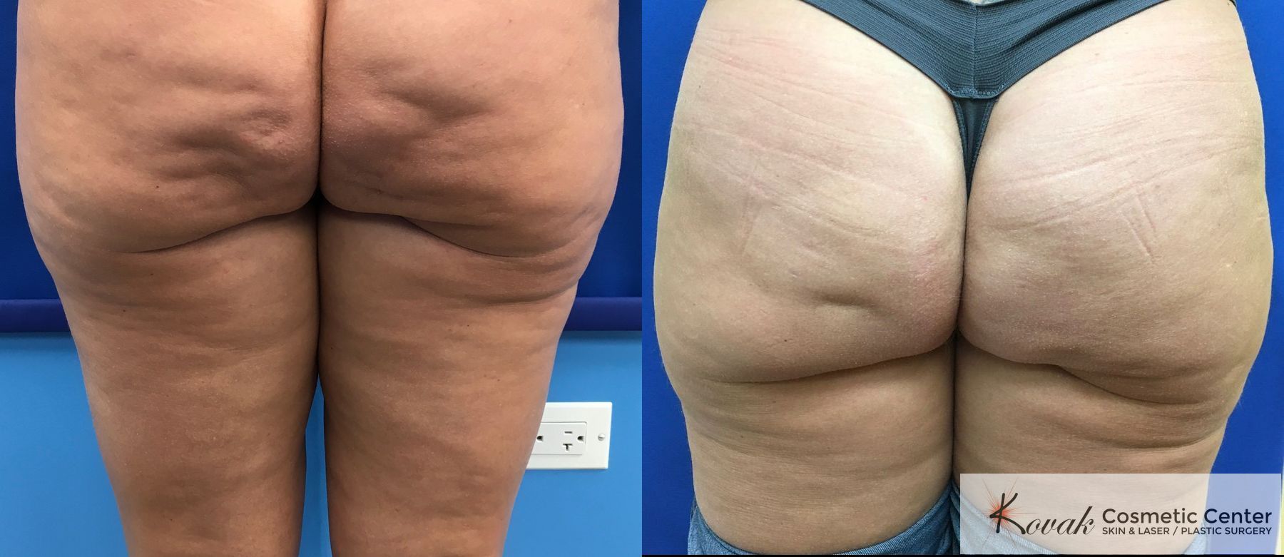 b12 injections for cellulite Cellulite Reduction – Kovak Cosmetic Center Chicago Illinois b12 injections for cellulite Cellulite Reduction – Kovak Cosmetic Center Chicago Illinois