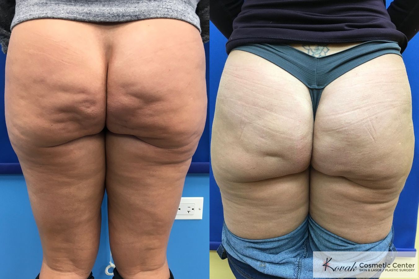 Cellulite Reduction Kovak Cosmetic Center Chicago Illinois Cellulite Reduction Kovak Cosmetic Center Chicago Illinois