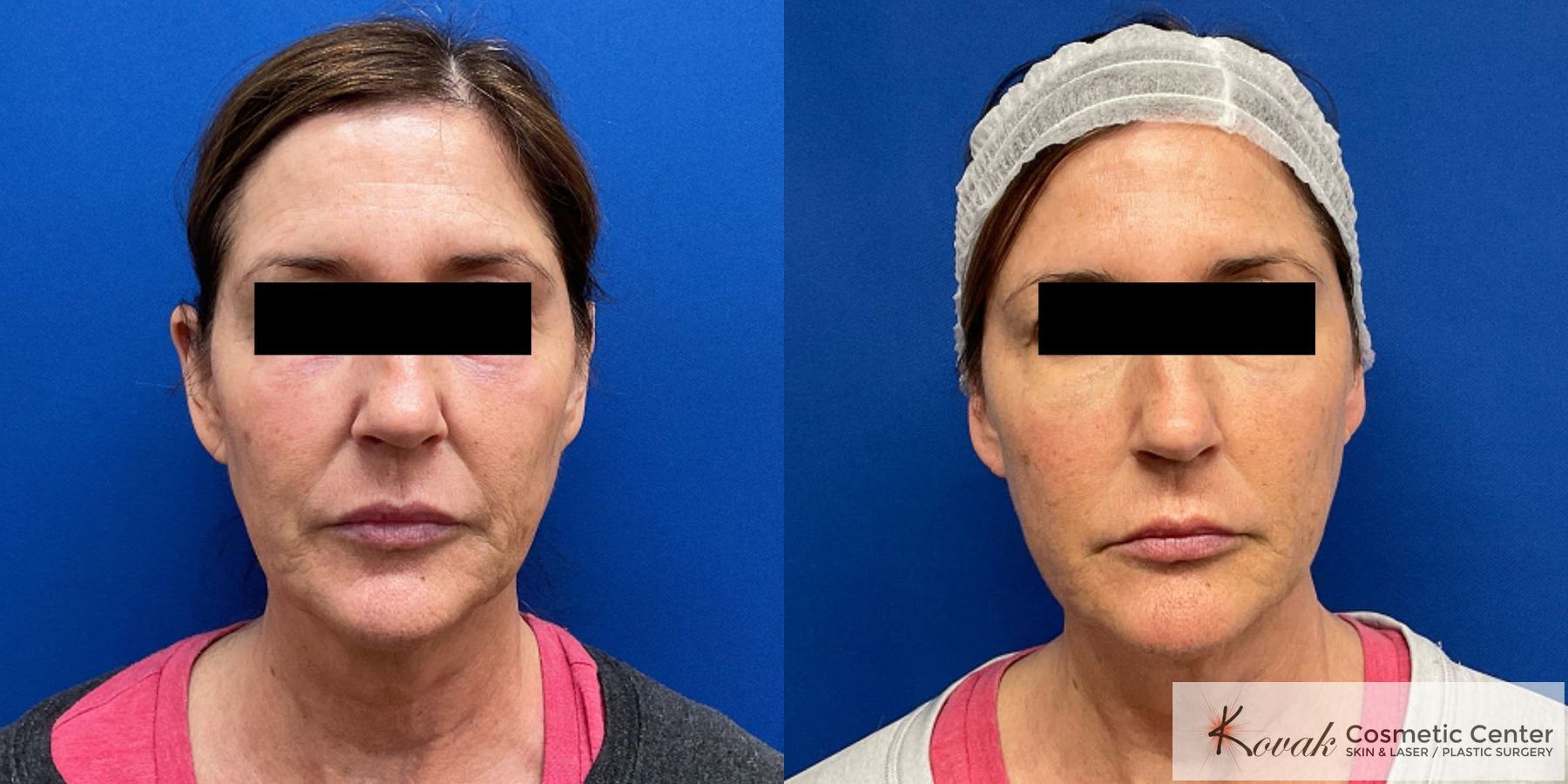 Before and after Ellacor - Microcoring Skin Rejuvenation Treatment case 36747