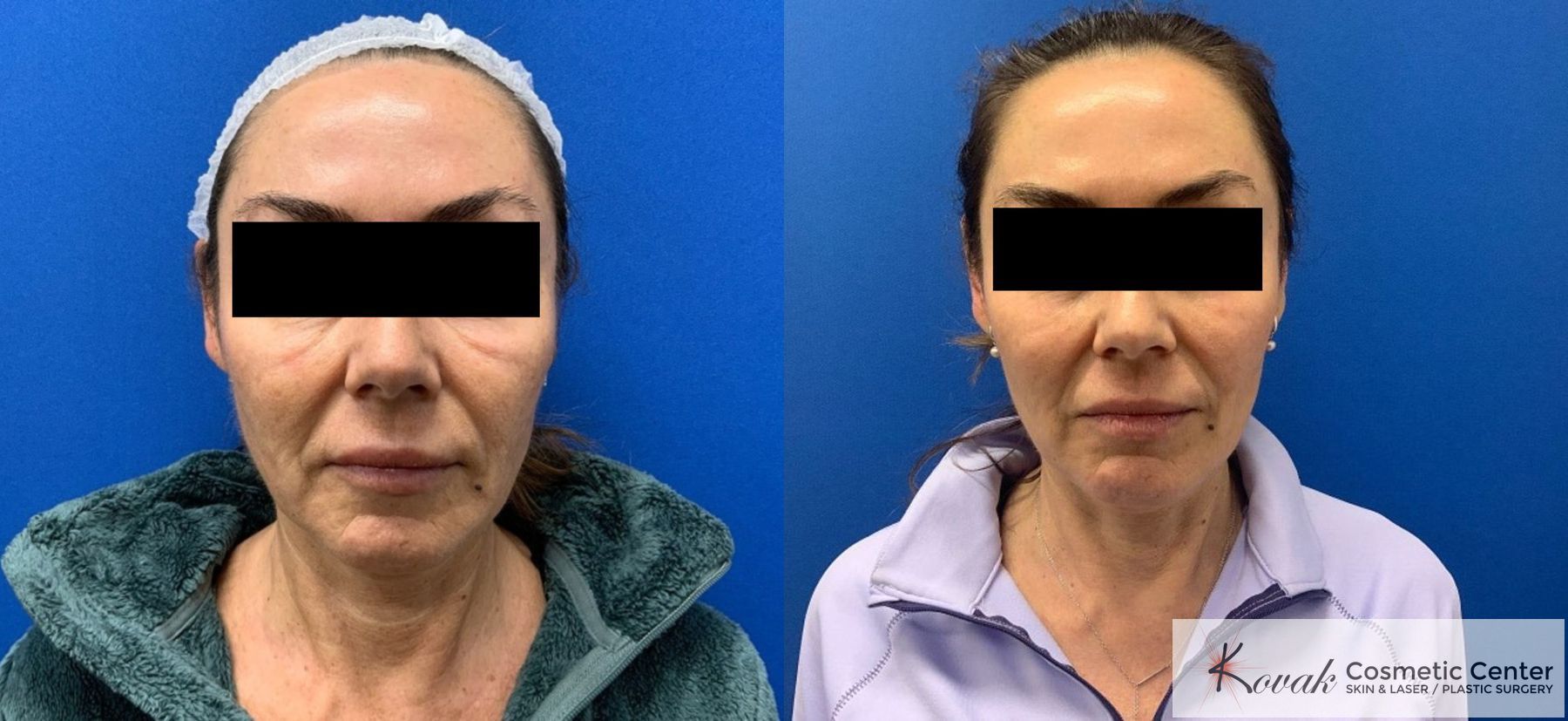 Before and after Ellacor - Microcoring Skin Rejuvenation Treatment case 36778