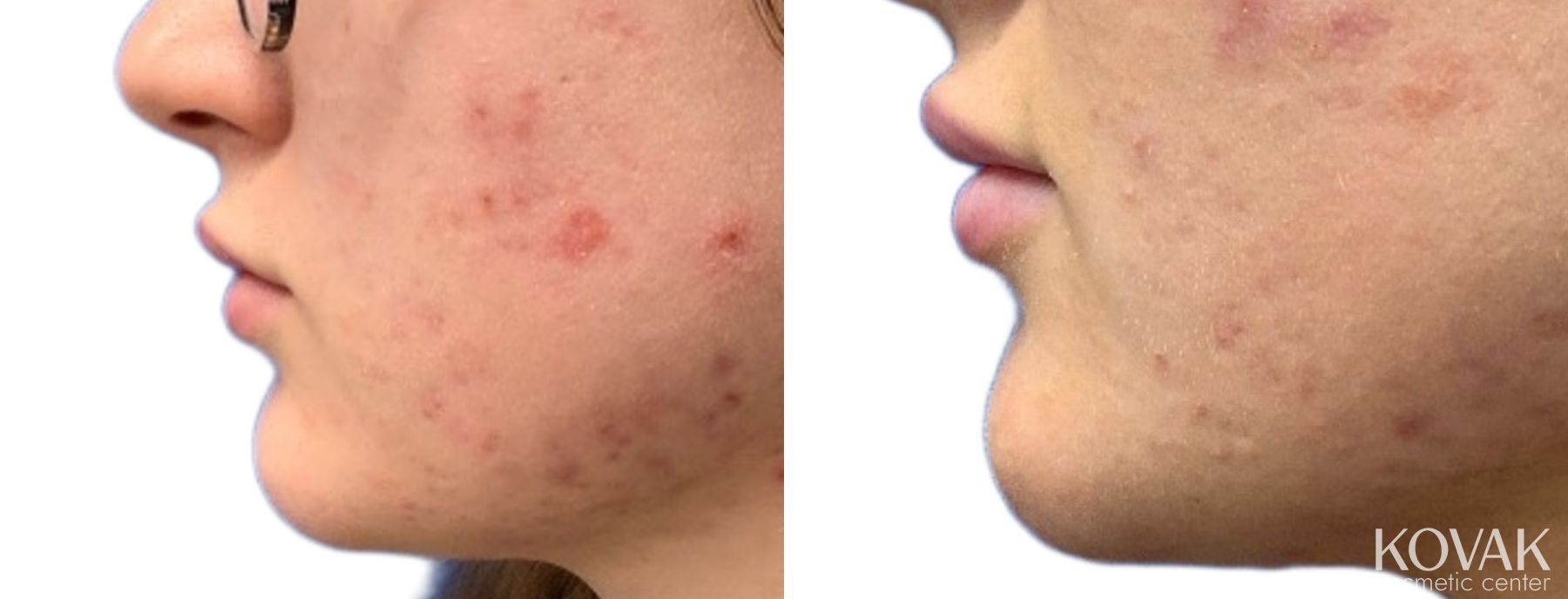 Before and after Lip Filler case 36764 - Angle 2