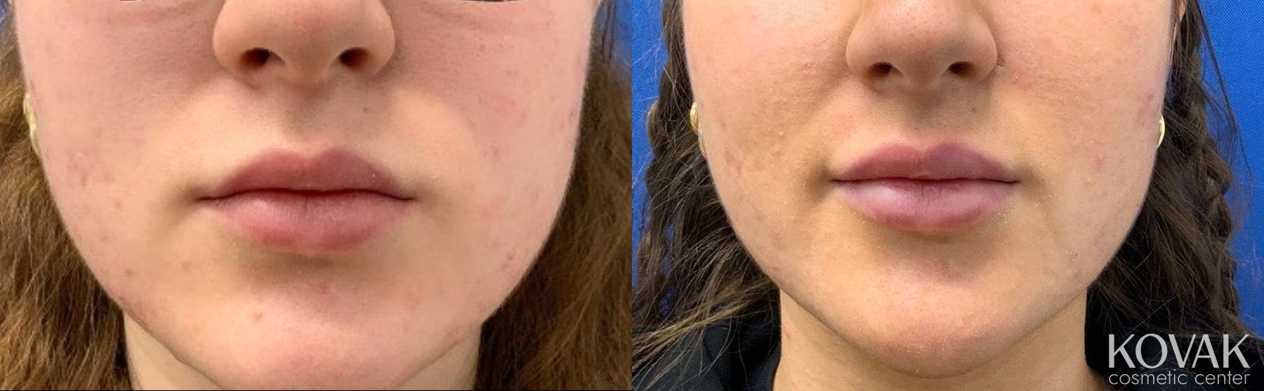 Before and after Lip Filler case 36764