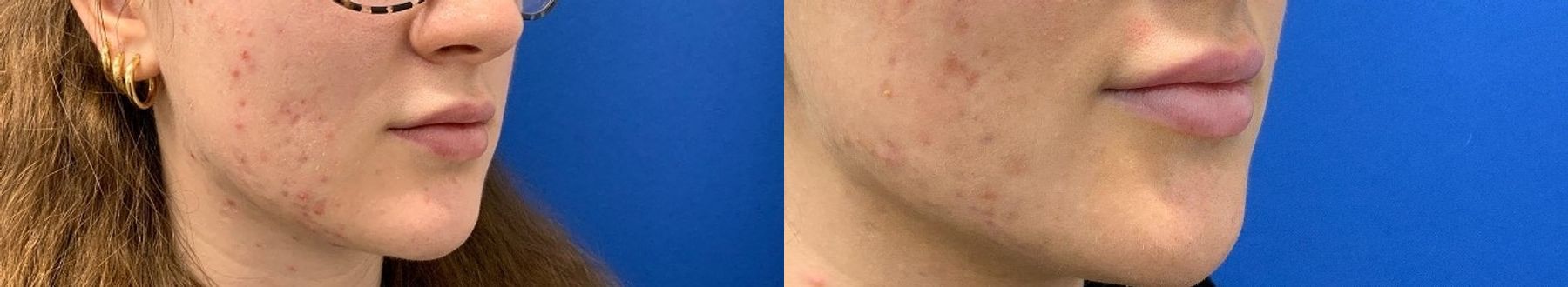 Before and after Lip Filler case 36764 - Angle 3