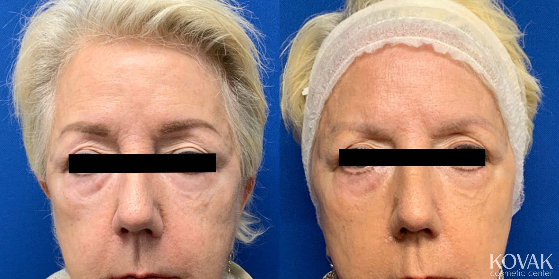 Before and after SylfirmX case 36775