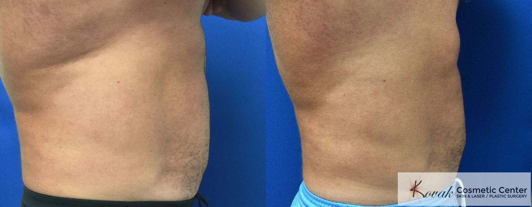 Emsculpt Neo - Thumbnail 2