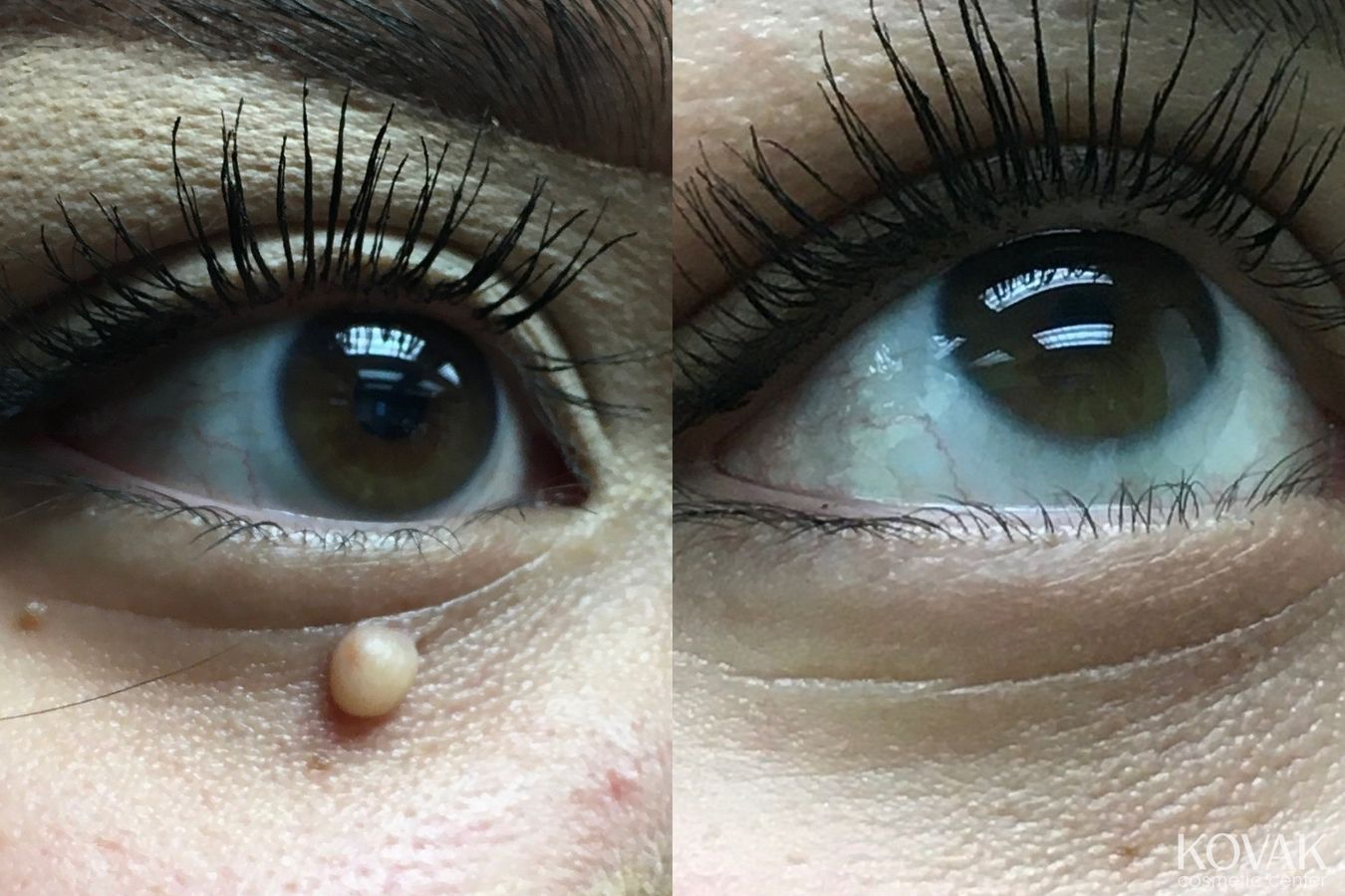 Before and after Mole Removal case 36674
