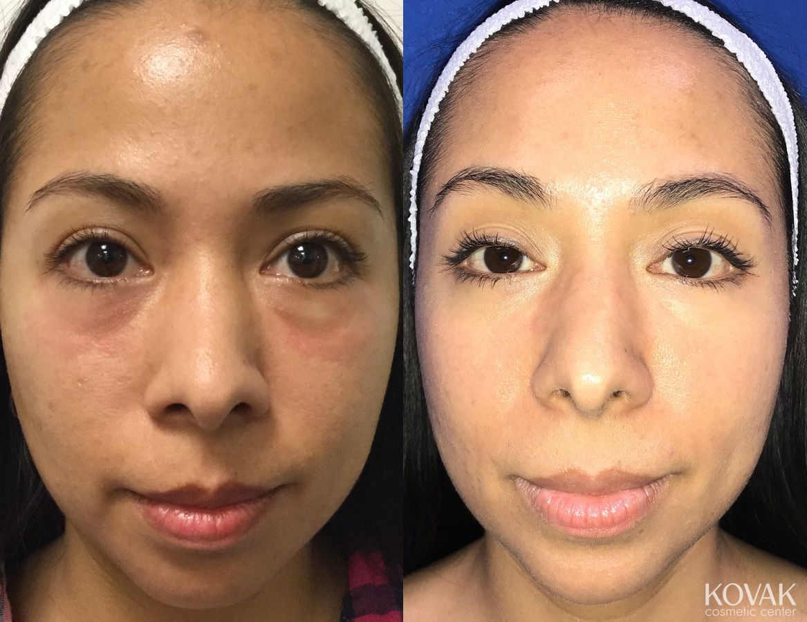 Before and after Injectables case 36589