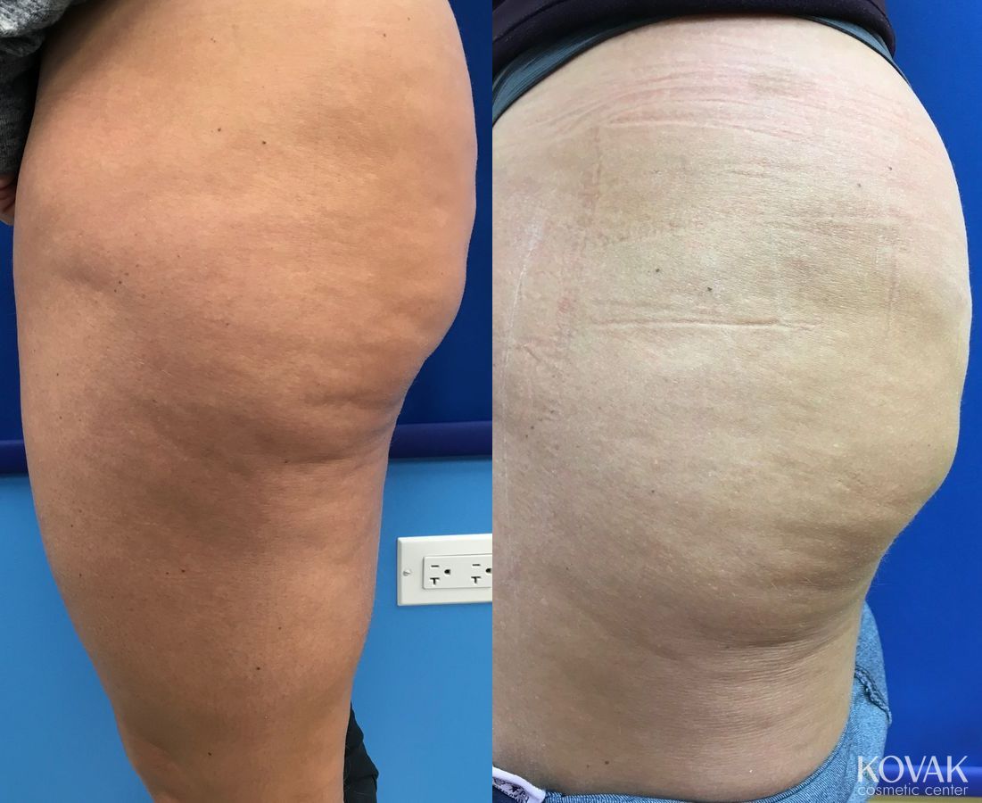 Before and after Cellulite Reduction case 36665 - Angle 2