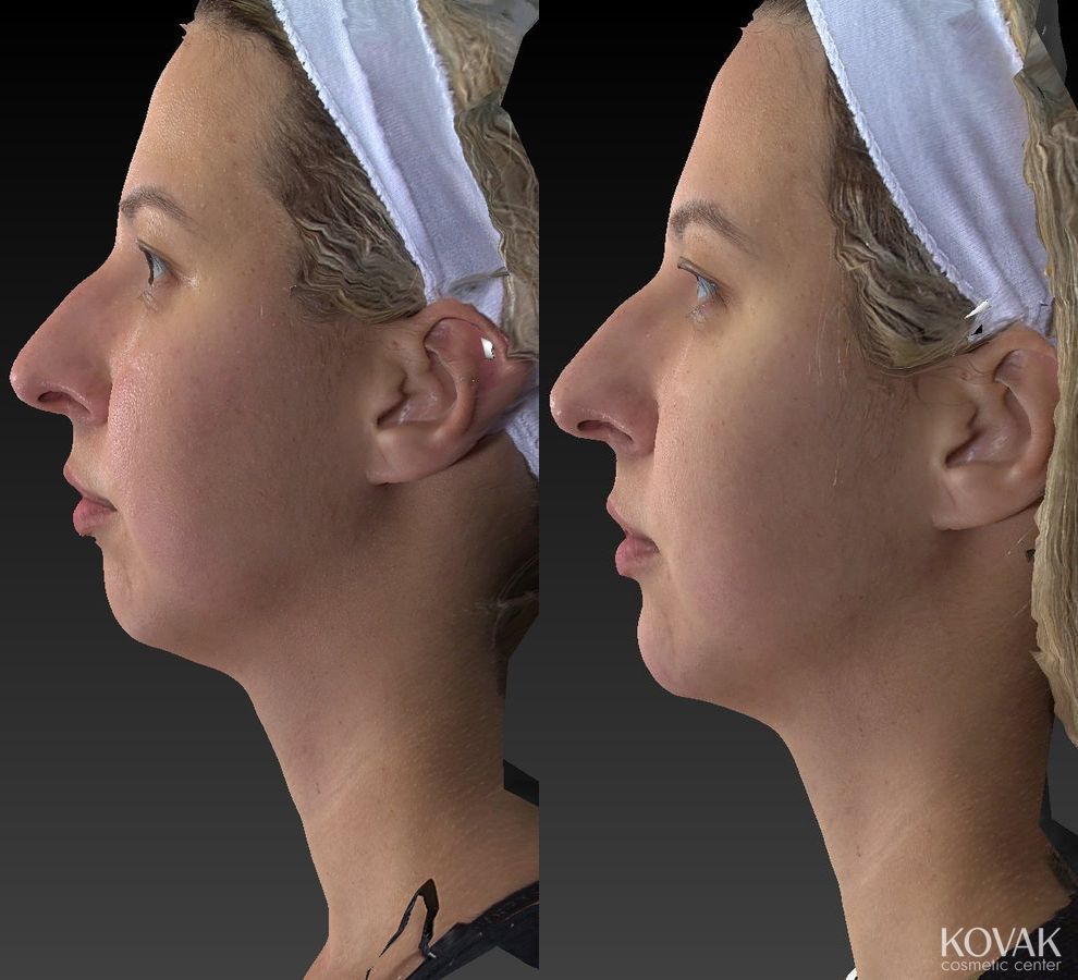 Before and after Restylane® Lyft case 36582 - Angle 2