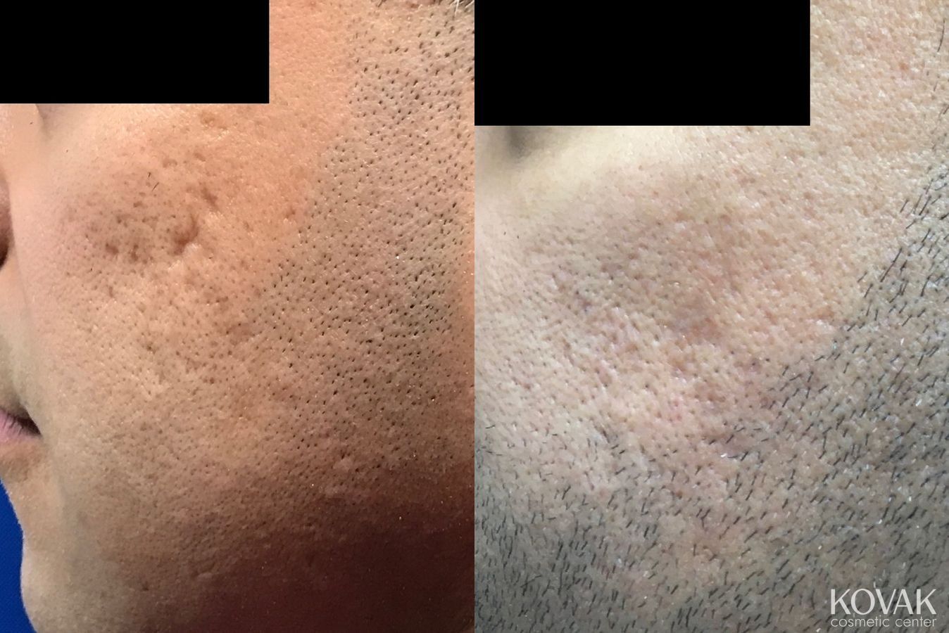 Before and after Acne Scars case 36642