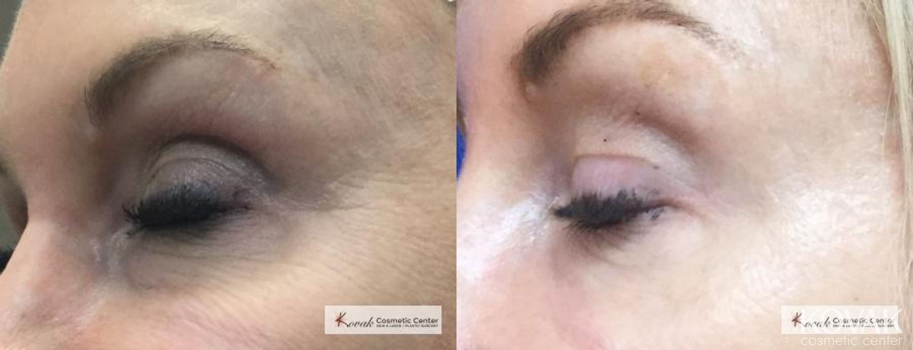 Before and after ThermiSmooth® case 36533 - Angle 2