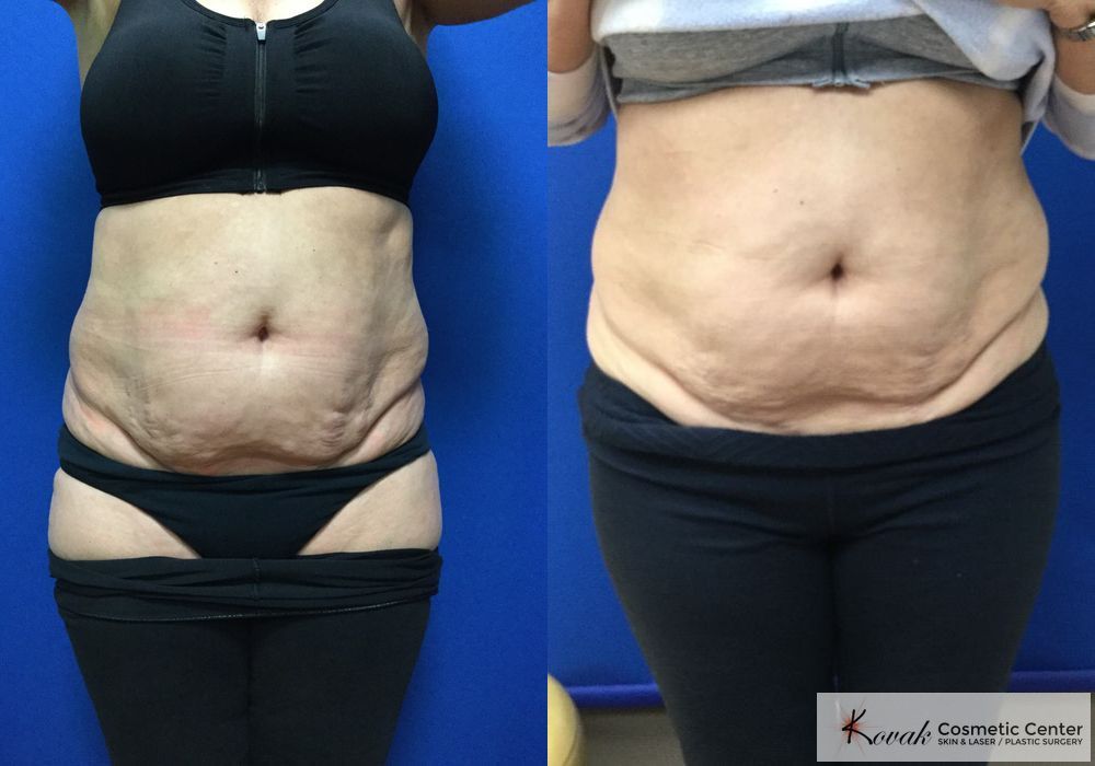 Emsculpt Neo - Case 1458