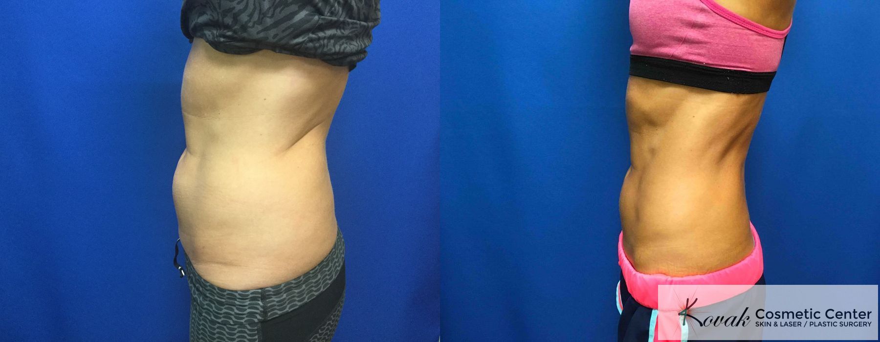 CoolSculpting® - Thumbnail 4