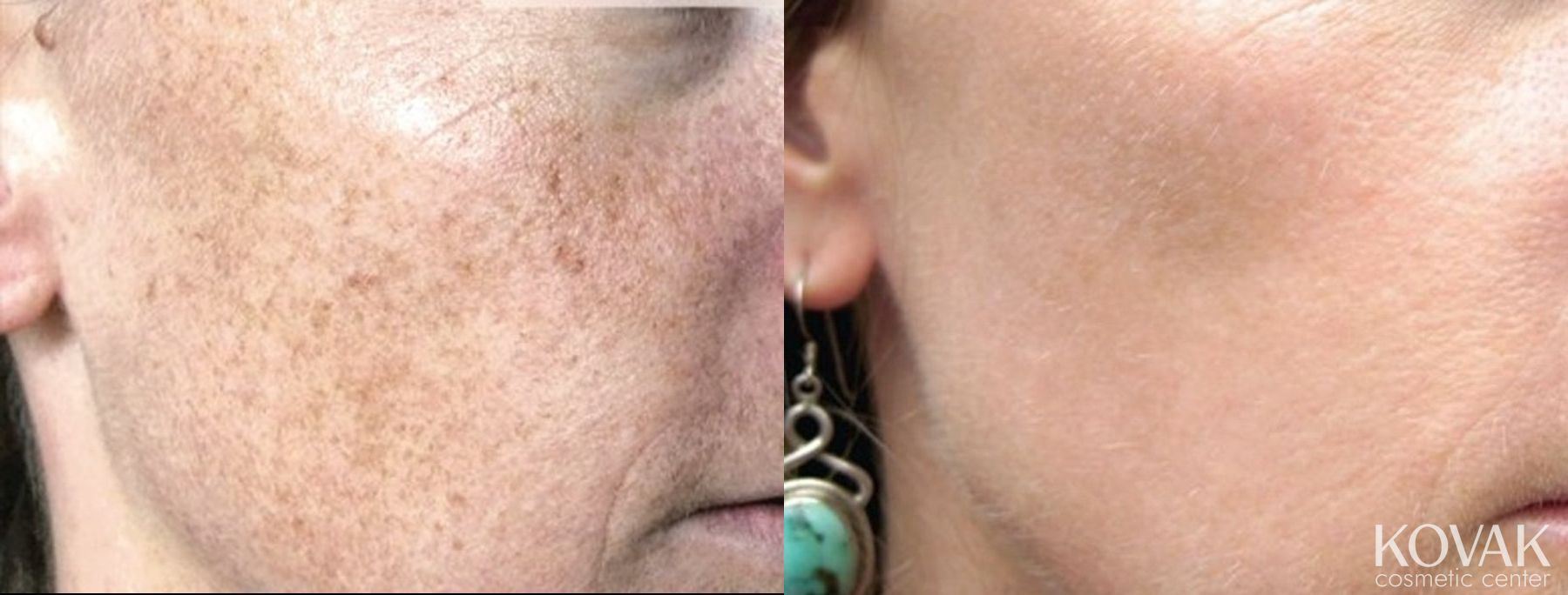 Before and after Tyte and Bryte Photorejuvenation case 36687