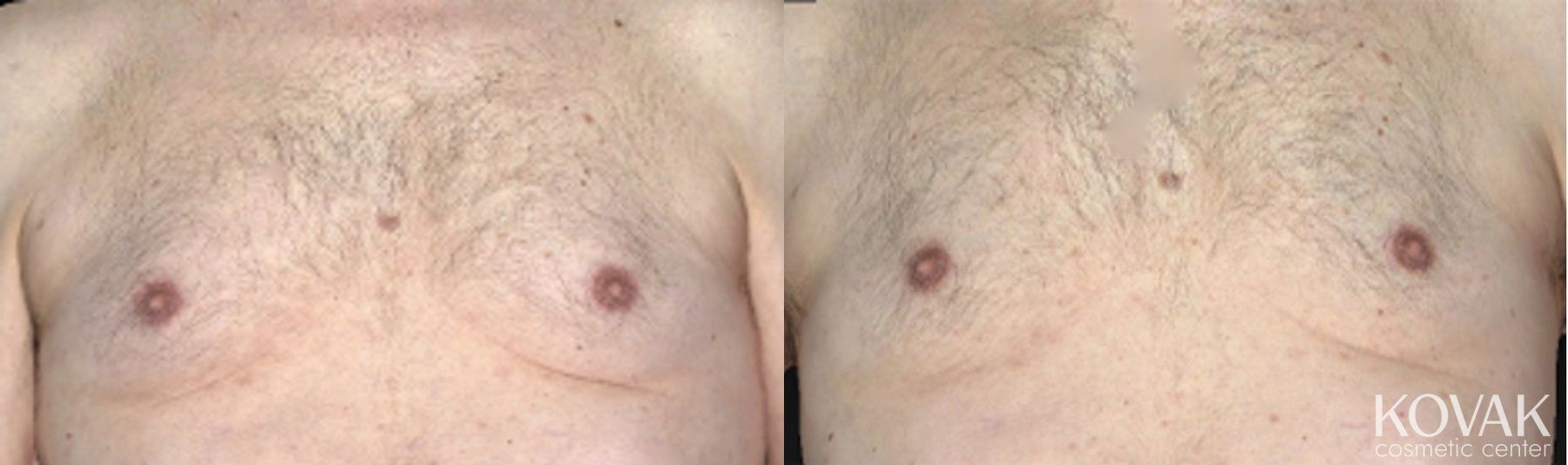 Before and after CoolSculpting® case 36475