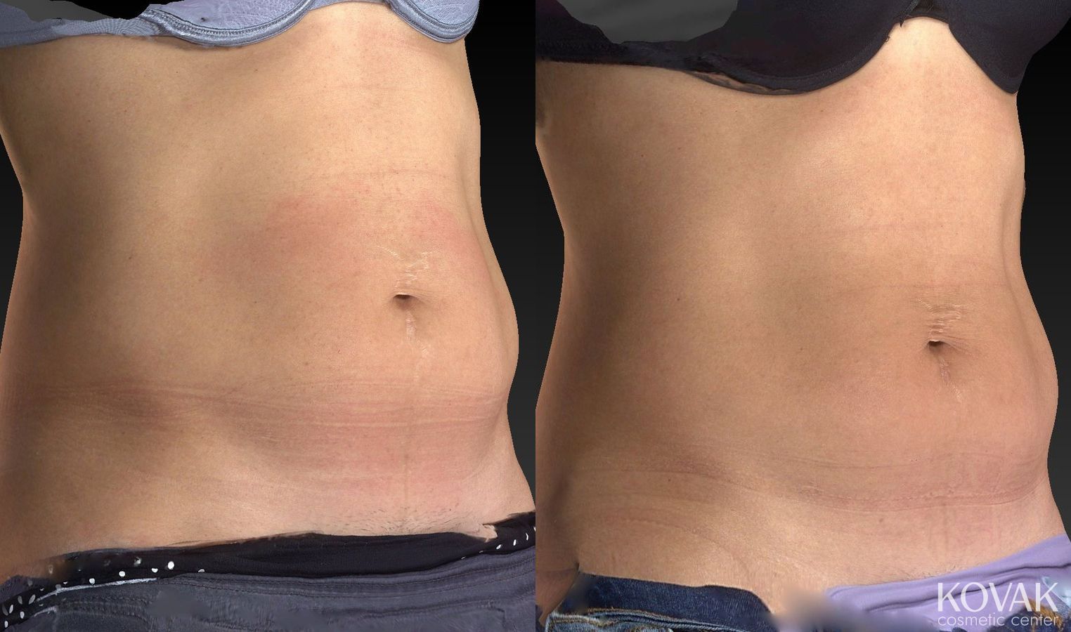Before and after CoolSculpting® case 36479 - Angle 5