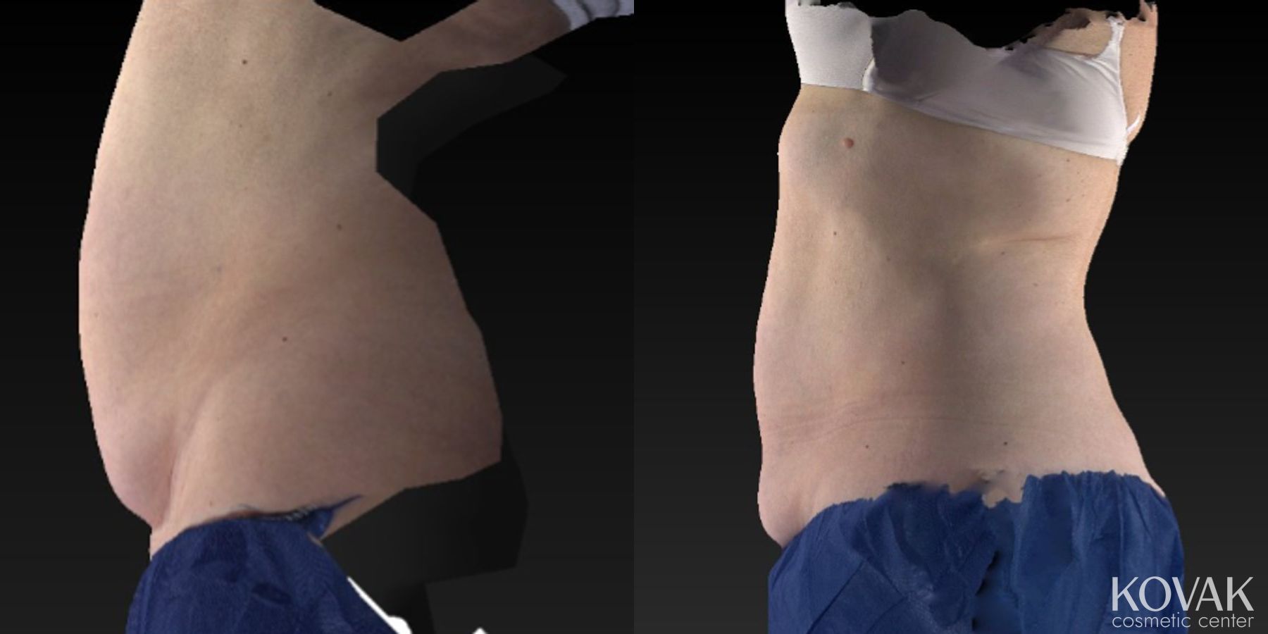 Before and after CoolSculpting® case 36564 - Angle 4