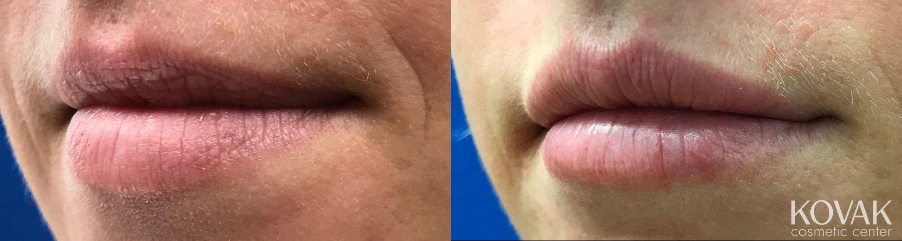 Before and after Restylane® case 36598