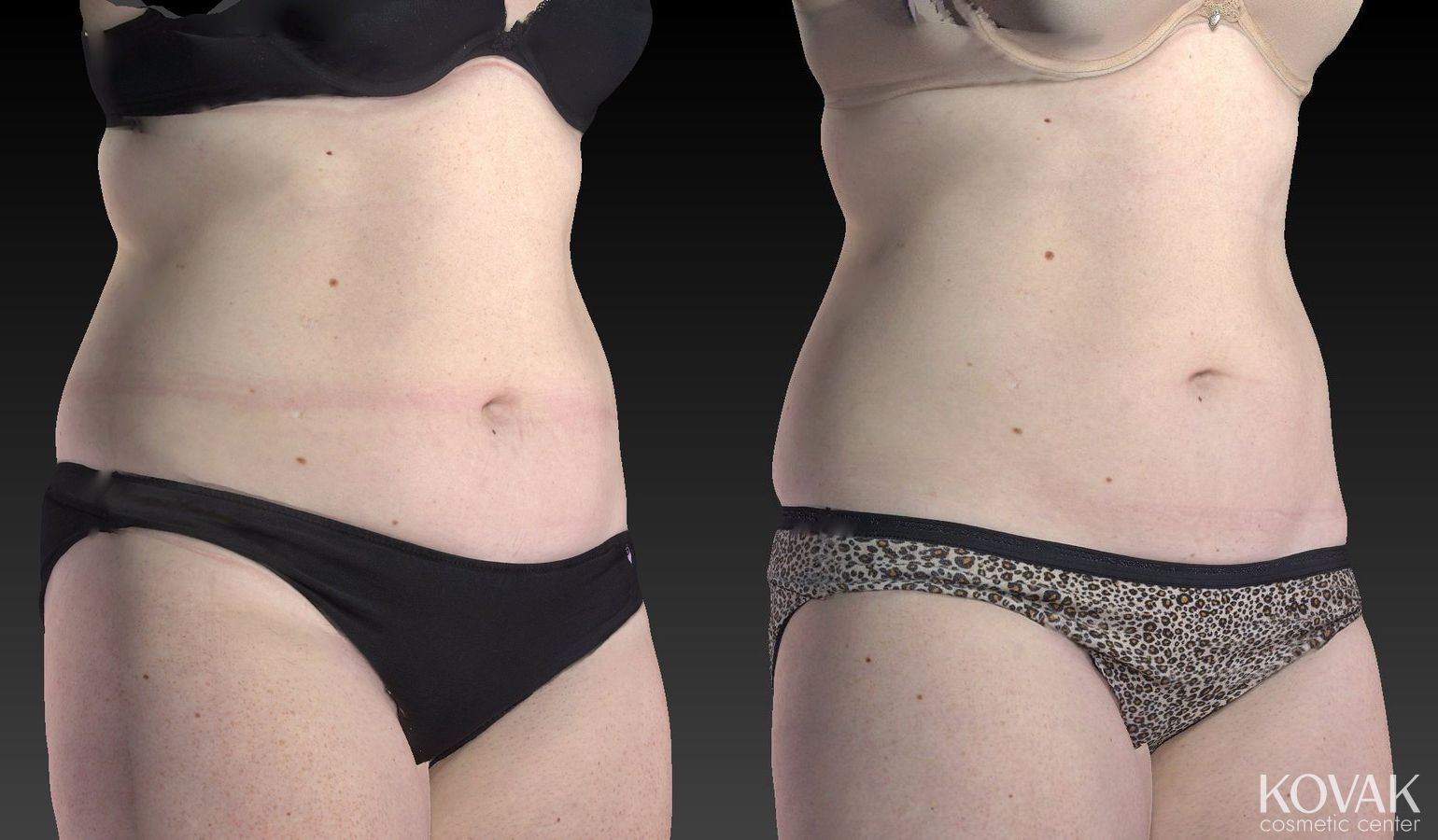 Before and after CoolSculpting® case 36604 - Angle 3